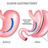 gastric.sleece.ray.83