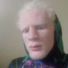 albino_guy