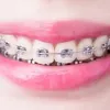 celebrities.w.braces1