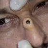 blackheadpurger