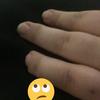 stumpyringfinger