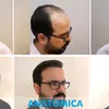 anatomicahairtransplant