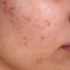 ForTheLoveOfPimples