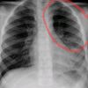 pulmones.3.2