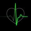 sinus_bradycardia