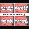 braces_ti_zanmi92