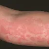 Giải pháp giảm mề đay dị ứng