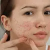 Acne Skin