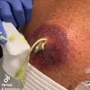 PimpleJ