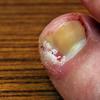 ingrown.nail