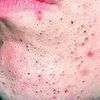 squeeze_acne3