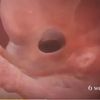 altfetus