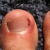 ingrowntoenail96