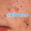 pimples.pi