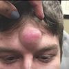 Dr Simple Pimple 10