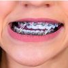 gabybraces