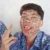 anakne_tulen