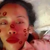 roseabacial