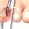 ingrown.toenail.removal