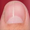 fingernailexplode