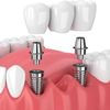 dental.lmplants