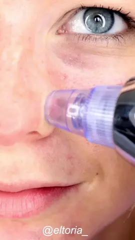 BLACKHEAD SUCTION DEVICE! OUCH! 🤕 #foryoupage #foryou #DIY #diybeauty #beautyhacks #beauty