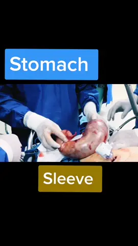 #stomach #gastricsleeve #surgery #weightlosssurgery #tiktokdoc #EduTok #surgeon #doctor #anatomy