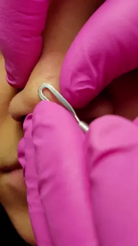 #extractions #cloggedpores #pimplepopping #drpimplepopper #facial #esthetician #estheticianlife #intoskin #fyp @kristin.intoskin