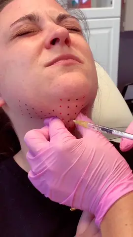Kybella sessions - we love seeing results! book for a treatment! 💉💕💋💥#FashionFavorites #injections #fyp #foryoupage #arizona #kybella #summer2020