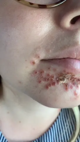 Responding to some of your comments! #fyp #foryoupage #foryou #theordinary #theordinaryskincare #skincare #impetigo @skincarebyhyram #hyram