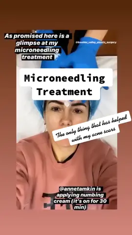 Microneedling is amazing for acne scars! #skincare #skincareroutine #acneskin #microneedling #skincaretips