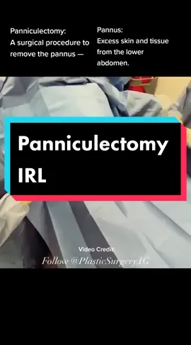 Surgery IRL: Panniculectomy 😷 #ormurse #surgery #medical #nursing #operatingroom #fyp #medtok #LearnOnTikTok