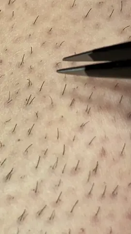 #ingrownhair #satisfying #satisfyingvideo #foryoupage #foryou #fyp
