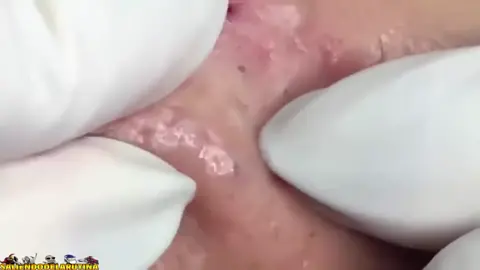 like si te gusta ver cómo quitan espinillas #pimple #pimples #lol #espinillagigante #parati