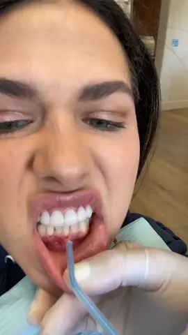 Root caries happen around gum!!! #fixit #viral #fyp #dentist #cavity #health #beauty