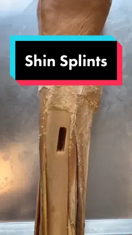 SHIN SPLINTS!! It’s real name is Medial Tibial Stress Syndrome. #LearnOnTikTok #tiktokpartner #shinsplints #todayilearned