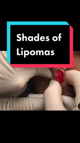 Lipomas are like snowflakes ❄️, there's never one identical to another... #drpimplepopper