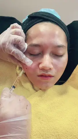 Dermapen prp. Prp guna plasma darah sendiri. Rawatan yg sgt popular di US. Sape yg x pernah tau rawatan ni mmg jakun🤣