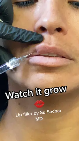 💋 #lip #filler #Botox #lips #makeup #fyp #foryourpage #YouHaveTo #kiss #makeup #tiktok #instagram #susacharmd