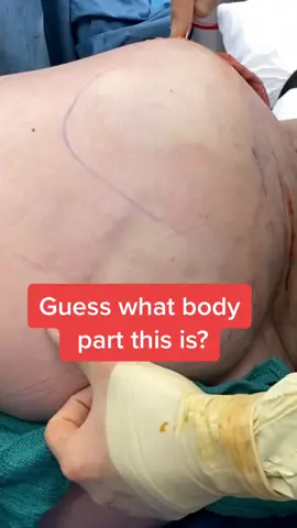 ASMR (OR Edition) 😏 #sosatisfying #plasticsurgery #bbl #cellulite #asmr #fyp #foryou