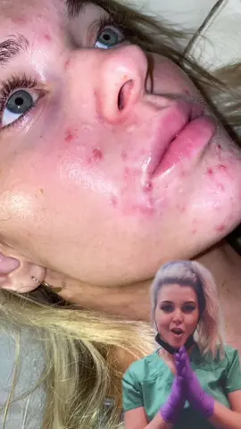 Whose ready for the full video of beauties’ #acnetreatment journey?! #fyp #beforeandafter