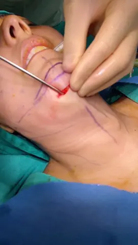 WTF is happening? 🤯 Comment 👉🏻👉🏻  #sosatisfying #chin #surgery #plasticsurgeon #FeelingGood #viral #foryou