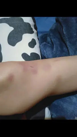 e thề chứ hôm nào về e cũng bị thâm tím cả ai công trình ma bị như e cho e ít ăn ủi với 😭😭😭 con gái ma chân như này đây