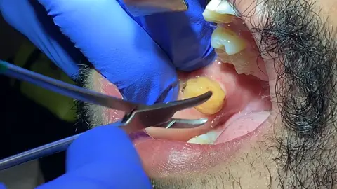 #buccalfat baby is back #plasticsurgery