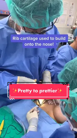 Rib cartilage harvest for a nose job (rhinoplasty) 👃🏼 #plasticsurgery  #rhinoplasty #LearnOnTikTok #doctor #fyp