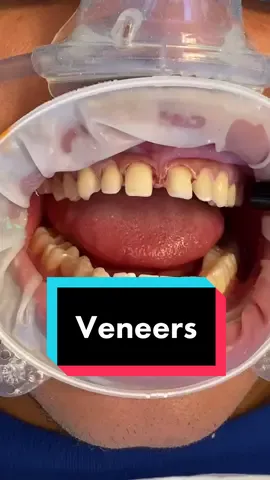 #veneers #beforeandafter #starttofinish #veneersjourney #dentist #teeth #LearnOnTikTok