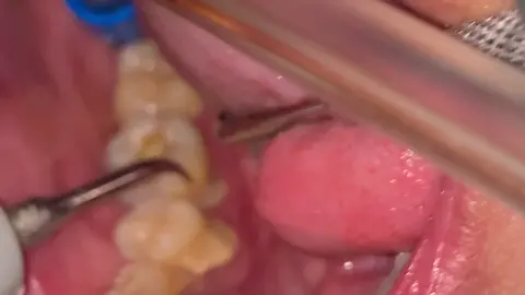 SCALING #scaling #dentist #doktergigi #satisfyingvideos
