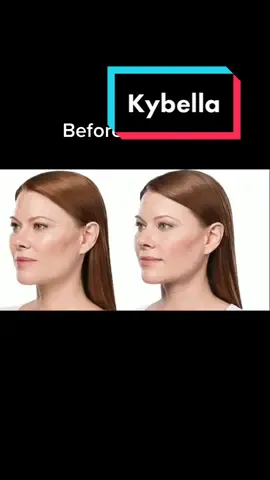 Reply to @chelsearosky #dermatologist #skincare #kybella #kybellainjections #doublechin