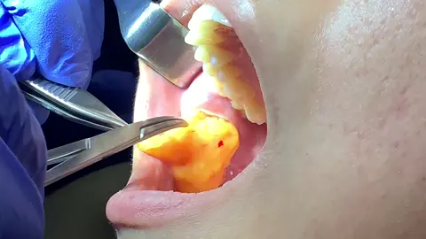 Buccal fats back alright  #plasticsurgery #sosatisfying #pimplepopper #pimplepopping