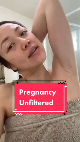 Pregnancy hyperpigmentation is real #pregnant #pregnancy #hyperpigmentation #skincare #twinpregnancy